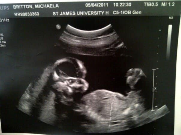 Ultrasound image showing a side profile of a developing foetus inside the womb, with the head, arm, and body visible against a dark background. "Never Again" is subtly overlaid above patient and hospital details at the top of the image.