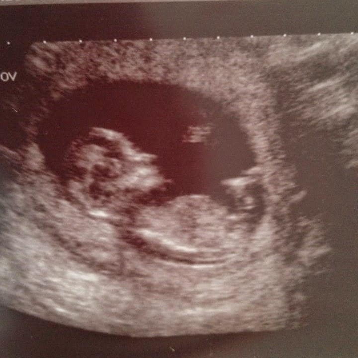 Black and white ultrasound image showing a developing foetus in the womb at pregnancy week 13, with the head, body, and limbs clearly visible in profile view.