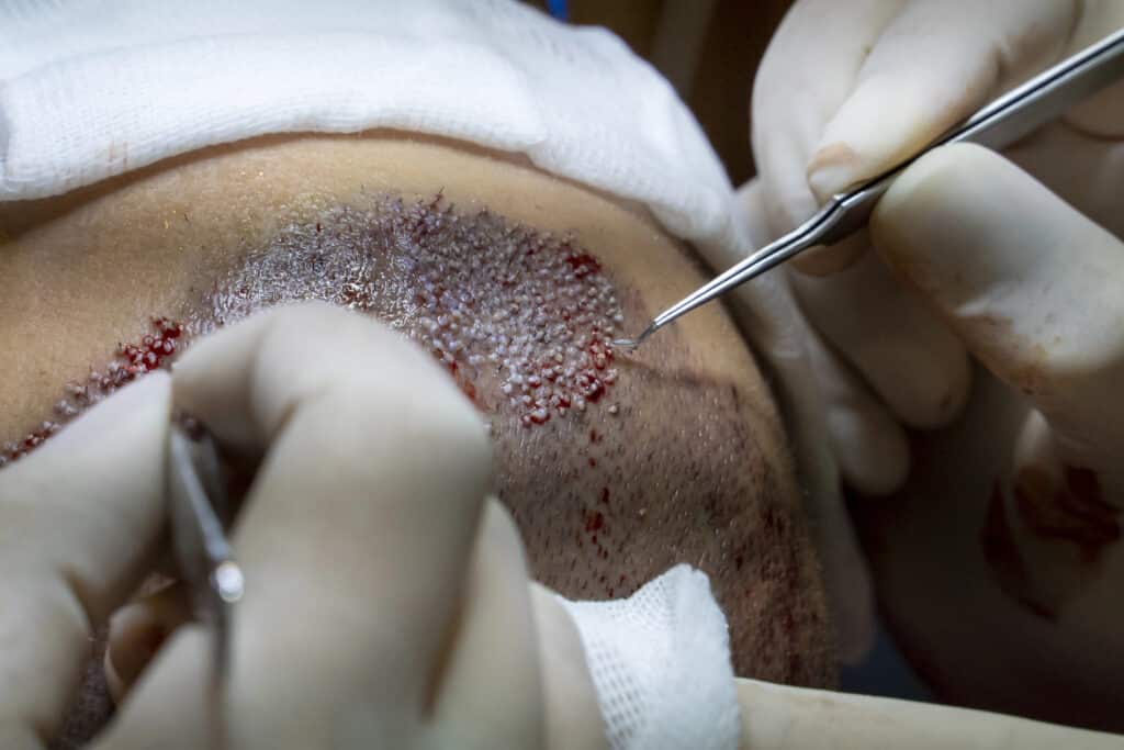Close-up of a hair transplant procedure showing gloved hands using surgical instruments to implant hair follicles into a receding hairline, with the scalp appearing red and dotted from newly placed grafts.